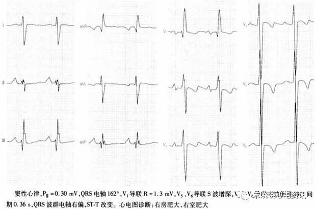 图18 右室肥大病例2心电图(4)双室肥大双侧心室产生的向量相等,可相互