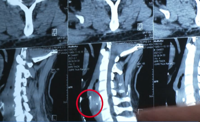 醫生初診時發現,他呼吸急促,脖子變粗,很可能是誤吞異物刺穿了食管