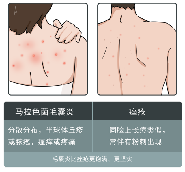 毛囊炎前胸和後背上的痘痘主要有兩種:然後再來對症下藥按嚴重程度將