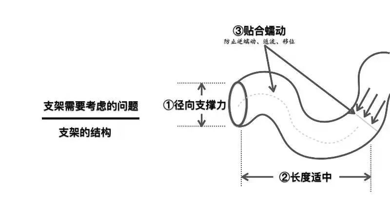 肠道|胃肠道支架-你的认识有多少？