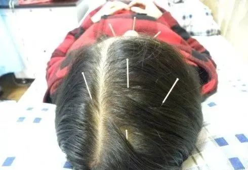 常见急症的针灸治疗——偏头痛,落枕_腾讯新闻