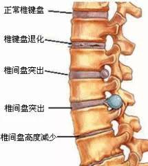 腰椎间盘突出症|腰椎间盘突出的各种疗法！看这一篇就够了！