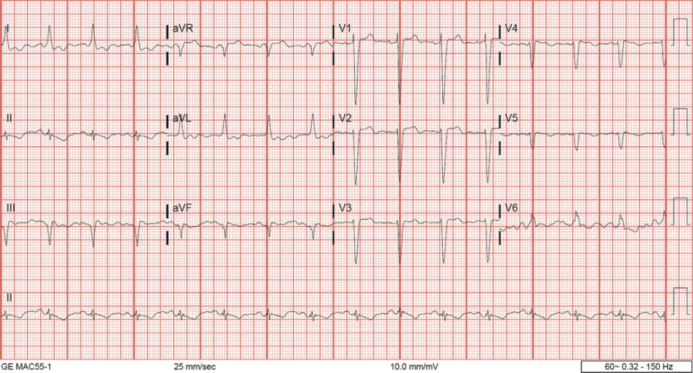 患者心电图st段恢复正常