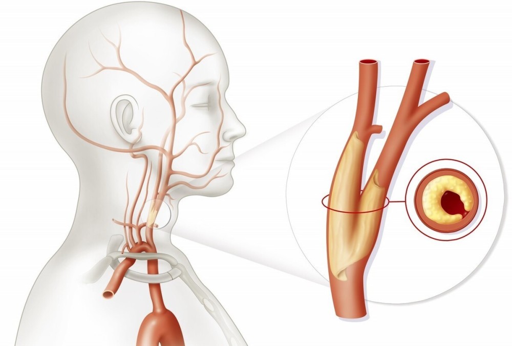 斑块|颈动脉斑块的危险性大不大？要看斑块的稳定性，还有厚度
