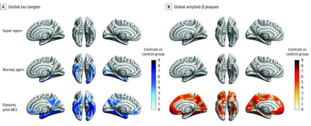 阿尔茨海默病|“超级老人”是如何阻止阿尔茨海默病和心智衰退的