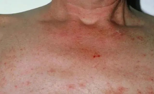 39岁男子,身上长"红点",确诊肝癌,出现5种异常,去查肝脏_腾讯新闻