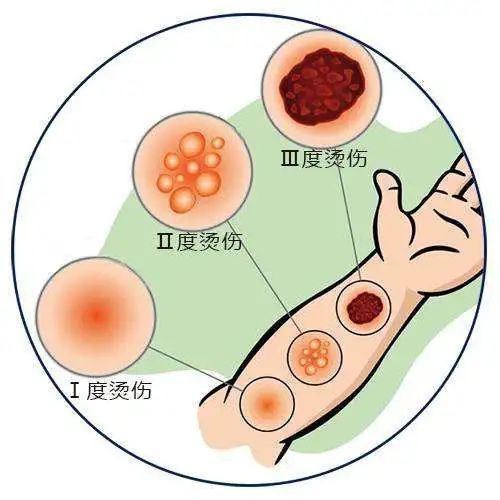 春节期间儿童不小心烧烫伤怎么办120教您现场急救窍门