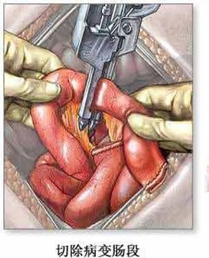 大年初六,李哥被切除掉0.8米发黑,坏死的小肠,剩余2.