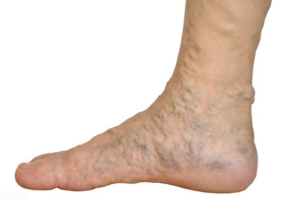 你的脚或脚趾甲会变白或变蓝,若是出现这样的症状则有可能是动脉硬化
