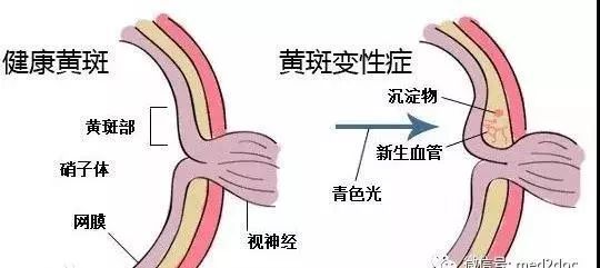 黄斑变性|“失明的隐形杀手”黄斑变性你了解多少？