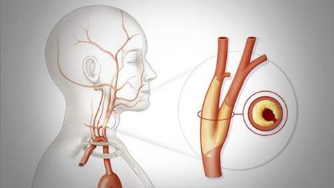 颈动脉狭窄|颈动脉狭窄患者千万别做这件事，或导致脑血栓