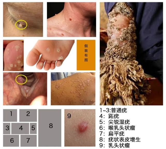 男生也要打吗?几岁打最有用?一文讲清关于hpv的一切