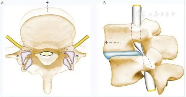 腰椎管狭窄症|腰椎管狭窄症