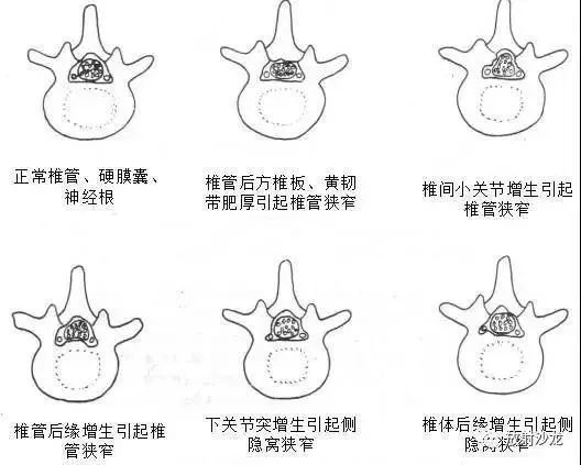 腰椎管狭窄症|腰椎管狭窄症
