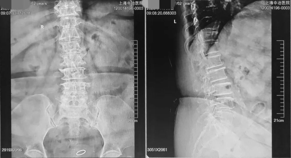 腰椎管狭窄症|腰椎管狭窄症
