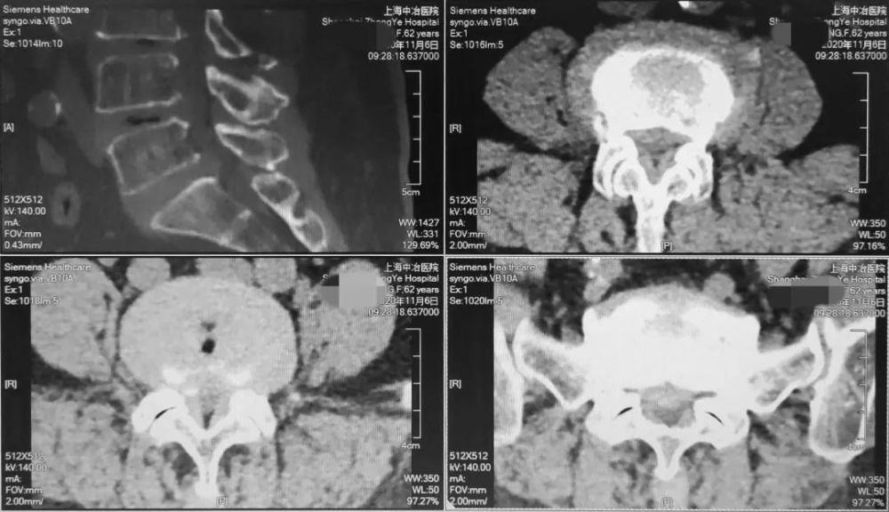 腰椎管狭窄症|腰椎管狭窄症
