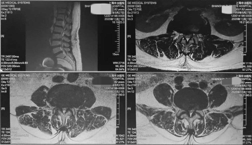 腰椎管狭窄症|腰椎管狭窄症