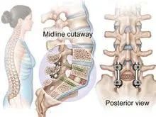 腰椎管狭窄症|腰椎管狭窄症