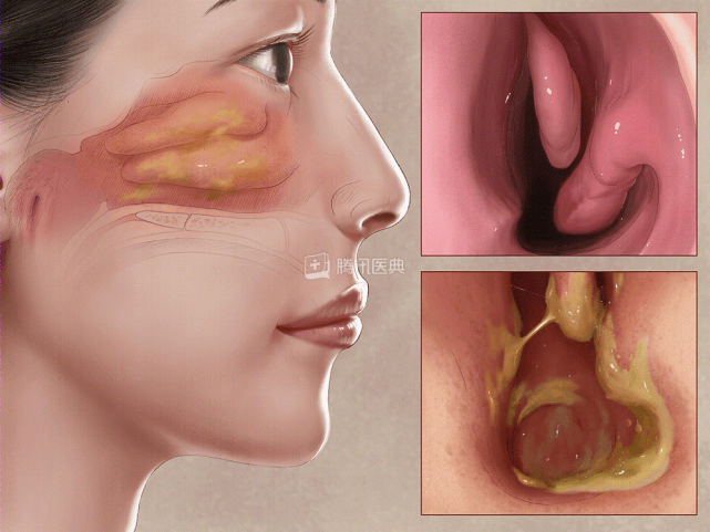 这类人最易中招|萎缩性鼻炎|鼻黏膜|鼻塞|鼻干|站酷海洛