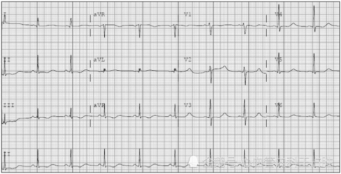 心电图|30岁男子胸痛，心电图心肌缺血，差点没被诊断为冠心病！