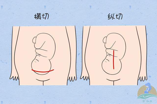 剖腹产切口位置图图片