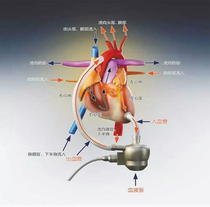心脏|花 100 万买一颗人工心脏，不是让你活到 200 岁的