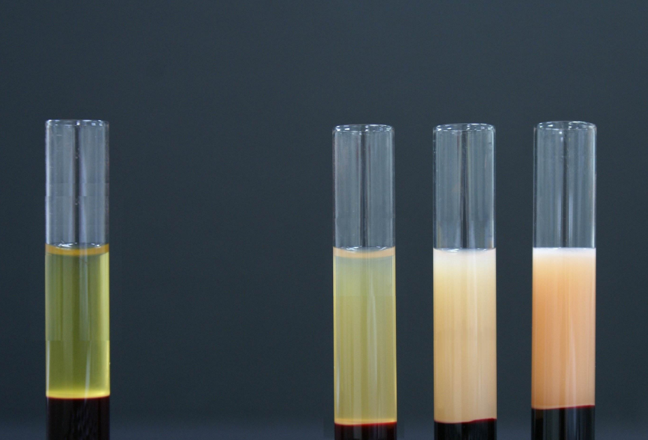 高脂血症|32岁高血脂男子喝了一碗骨汤后突发胰腺炎，抽血竟一半是油