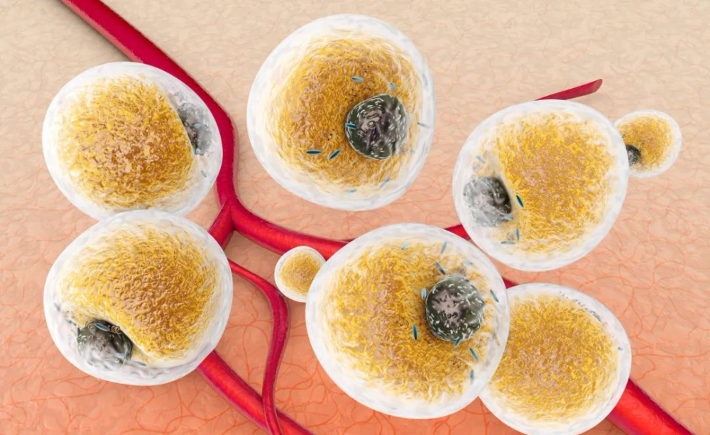 高脂血症|32岁高血脂男子喝了一碗骨汤后突发胰腺炎，抽血竟一半是油