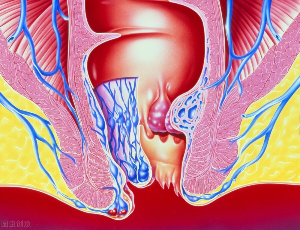痔疮|痔疮要想好的快，护理工作不能坏