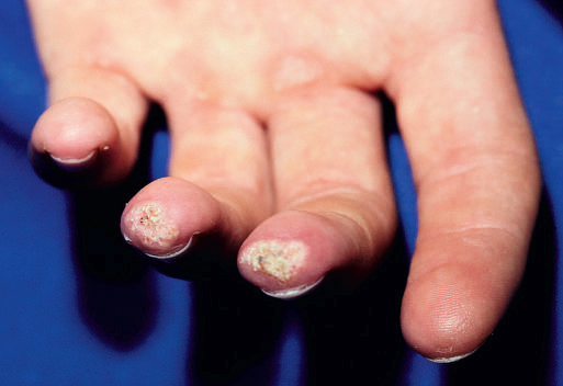 熟悉皮肌炎的皮肤改变,少一些误诊(下)