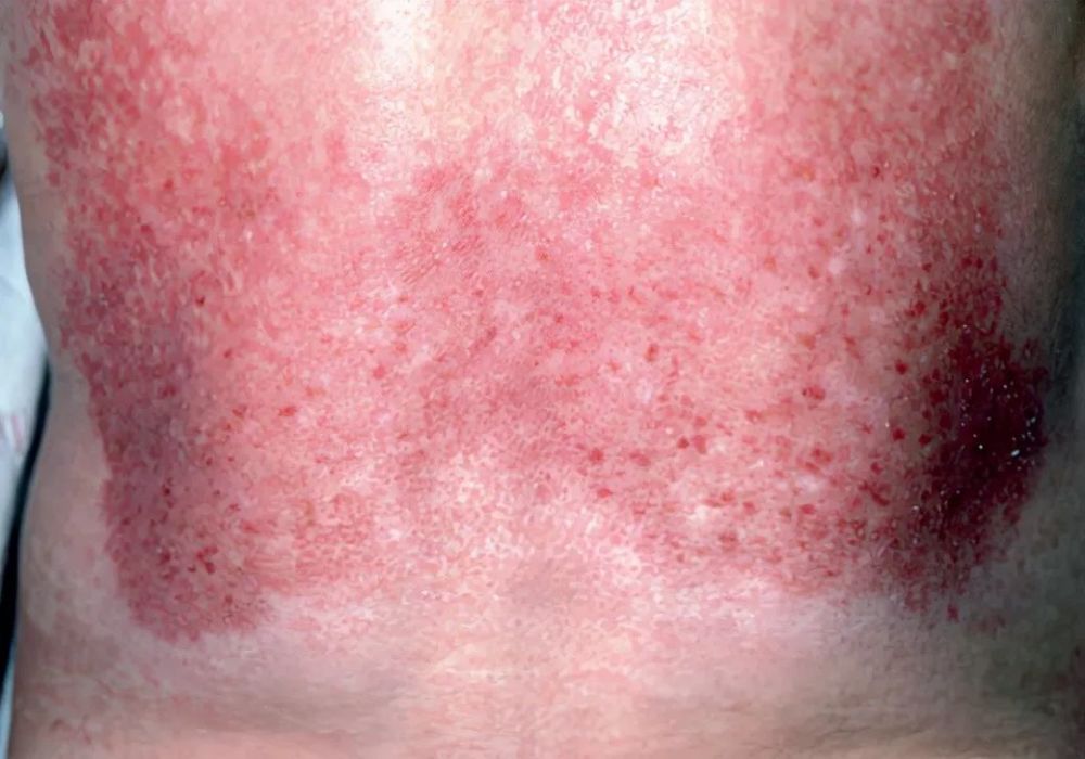 1,泛发性红皮病二,皮肌炎的少见皮肤改变幼年皮肌炎相对常见牙龈毛细