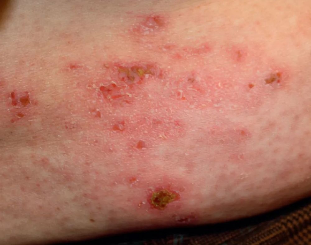 熟悉皮肌炎的皮肤改变少一些误诊下