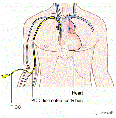 picc|PICC 维护及日常生活指导