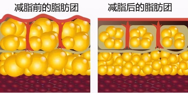 啤酒肚脂肪解剖图图片