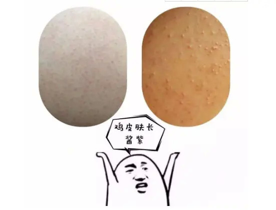 鸡皮肤怎么去角质最好(去脸部鸡皮肤角质比较好的护肤品)