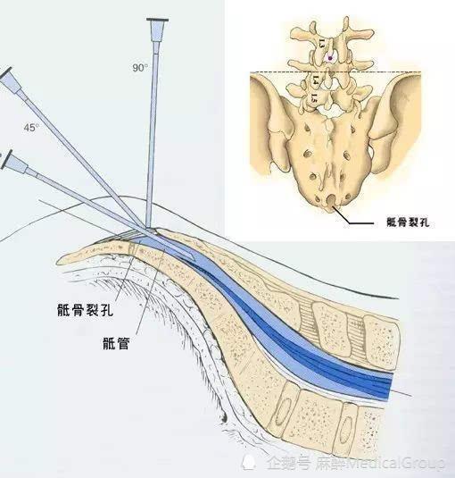 痔疮|做痔疮手术后腿动不了了，扑朔迷离的背后竟然是一根电线惹的祸