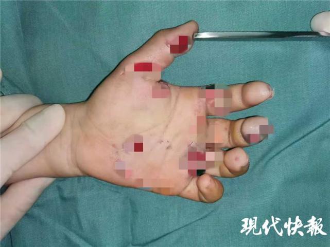 鞭炮惹祸!春节期间徐州多名儿童手指被炸伤