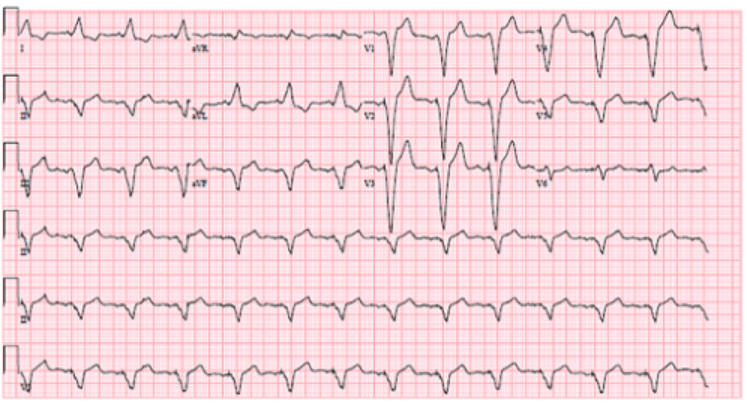 左束支传导阻滞|病例｜左束支传导阻滞合并急性心梗：Chapman征！