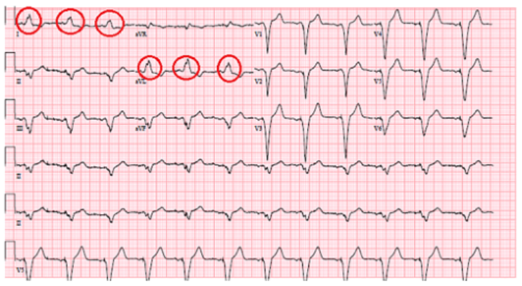 左束支传导阻滞|病例｜左束支传导阻滞合并急性心梗：Chapman征！
