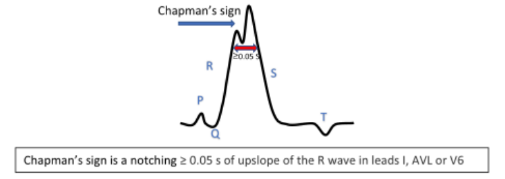 左束支传导阻滞|病例｜左束支传导阻滞合并急性心梗：Chapman征！