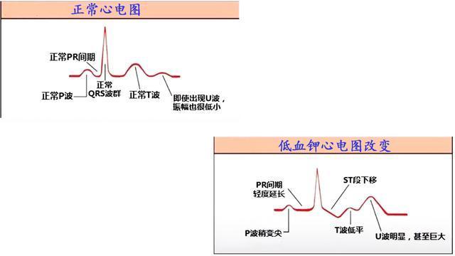 缺钾|缺钾有什么症状？