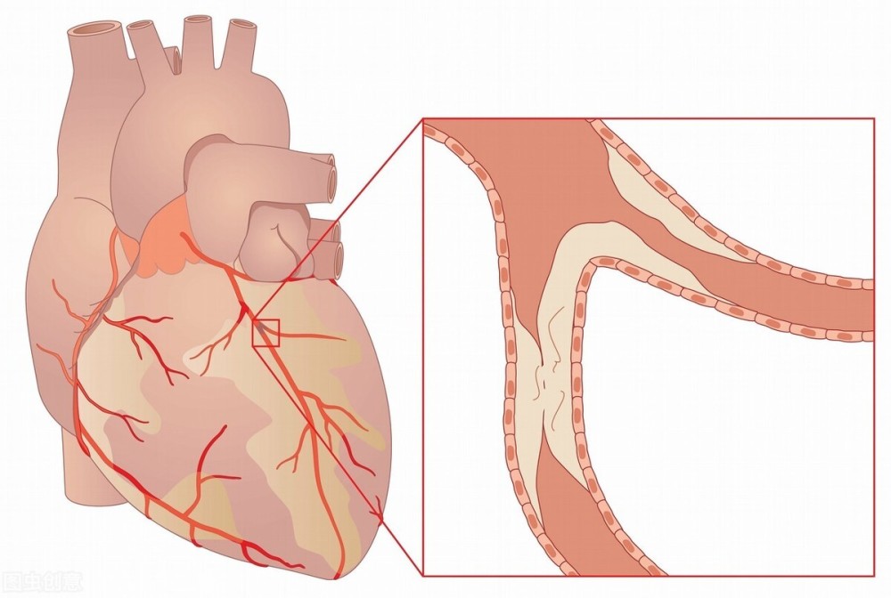 心脏病|为什么心脏病治疗“宜早不宜迟”？听听医生怎么说