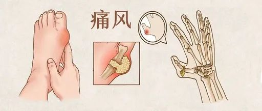 為何近十年痛風病高發醫生原因與喝的水有關