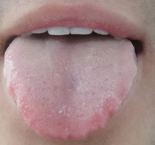 如果发现自己舌头的边上有被牙齿咯的印子,也就是齿痕,这是身体在提醒