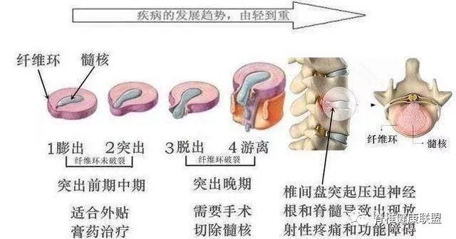 腰椎間盤突出多坐骨神經痛怎麼保養養護是關鍵