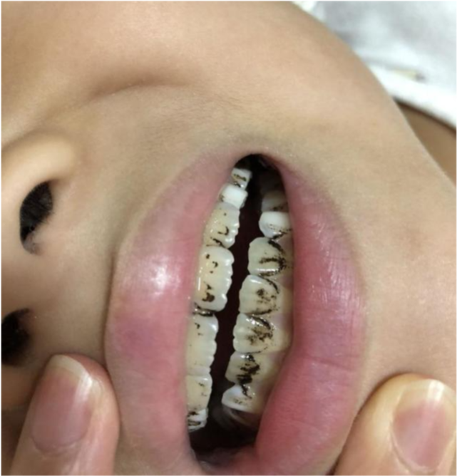 孩子的牙齿变黑怎么办?别害怕,很容易就能去除