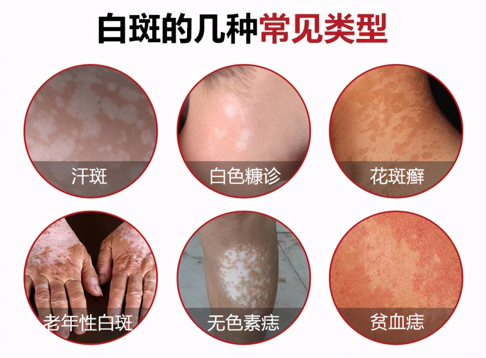 孩子脸上长白斑肚里有蛔虫医生不是蛔虫斑可能是癌