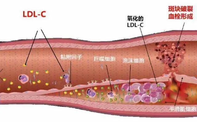 他汀|36岁颈动脉斑块，吃了1年他汀，医生提醒不要滥用药物