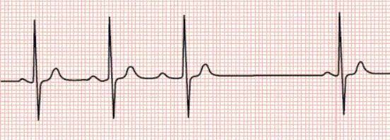 ii度房室传导阻滞(莫氏i型)