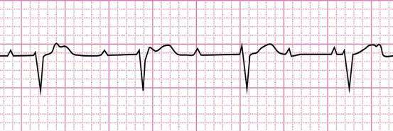 緩慢性心律失常急症的臨床和心電圖特點及處理_騰訊新聞